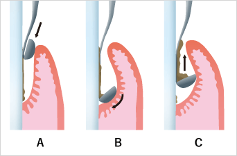 歯周疾患の治療イメージ