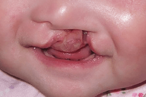 唇顎口蓋裂の事例