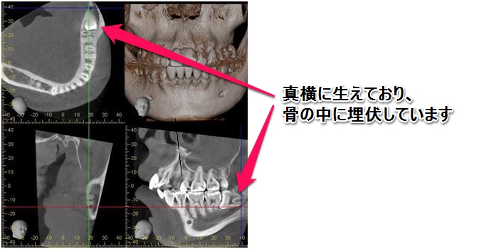 埋伏した親知らず