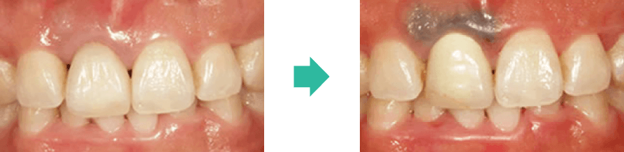 メタルコアの金属成分が溶け出して歯茎や歯茎の境目に入り込み、変色してしまうケースも確認されています。