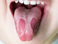 舌の病気